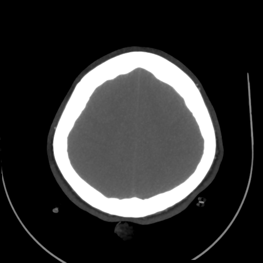 Colloid cyst (resulting in death) (Radiopaedia 33423-34499 A 47).png