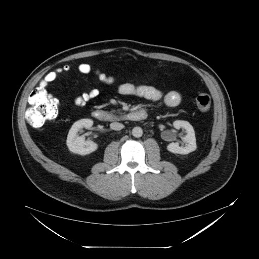 Colocolic intussusception due to lipoma (Radiopaedia 73712-84508 A 51).jpg