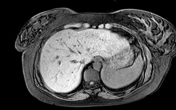 Colon adenocarcinoma with Krukenberg tumors, advanced pregnancy (Radiopaedia 67279-76645 A 72).jpg