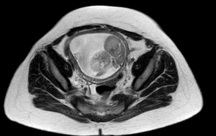 Colon adenocarcinoma with Krukenberg tumors, advanced pregnancy (Radiopaedia 67279-76645 Axial T2 17).jpg
