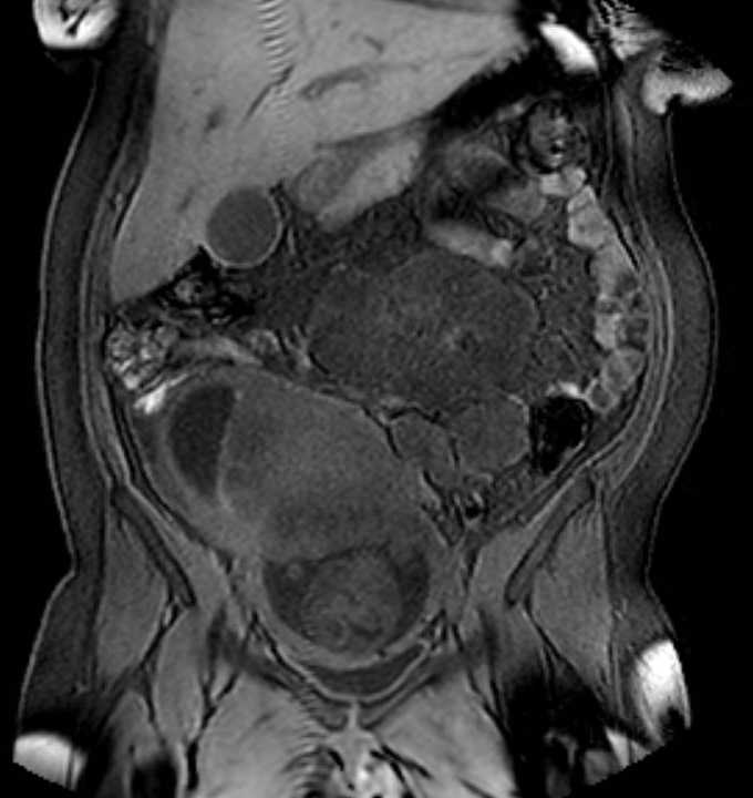 Colon adenocarcinoma with Krukenberg tumors, advanced pregnancy (Radiopaedia 67279-76645 E 36).jpg