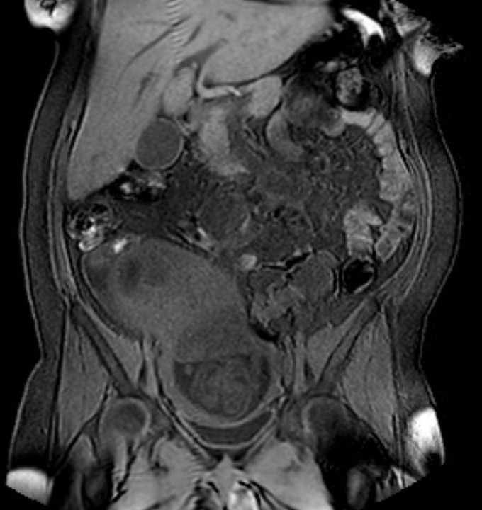 Colon adenocarcinoma with Krukenberg tumors, advanced pregnancy (Radiopaedia 67279-76645 E 40).jpg
