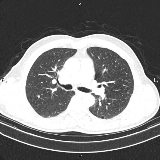 File:Colon cancer (Radiopaedia 85663-101443 Axial lung window 27).jpg