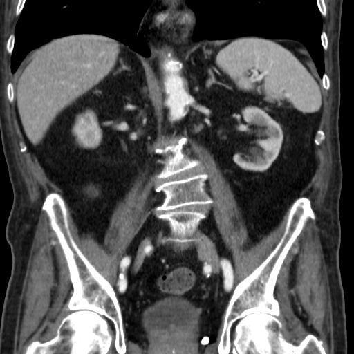 File:Colon cancer with duodenal invasion (Radiopaedia 16278-15958 B 37).jpg