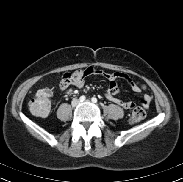 Colon carcinoma with hepatic metastases (Radiopaedia 29477-29961 A 72).jpg