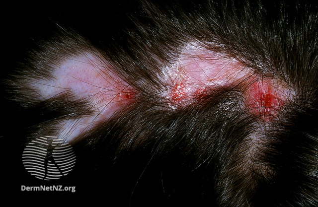File:Discoid lupus erythematosus (DermNet NZ hair-nails-sweat-lupus-scalp).jpg