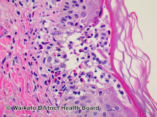 File:Figure 1 (DermNet NZ pathology-w-eosinophilic-folliculitis-fig-1).jpg