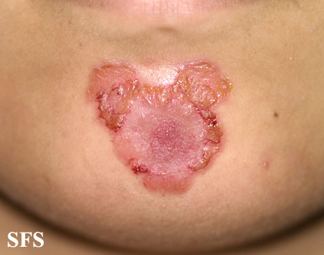 File:Impetigo (Dermatology Atlas 29).jpg