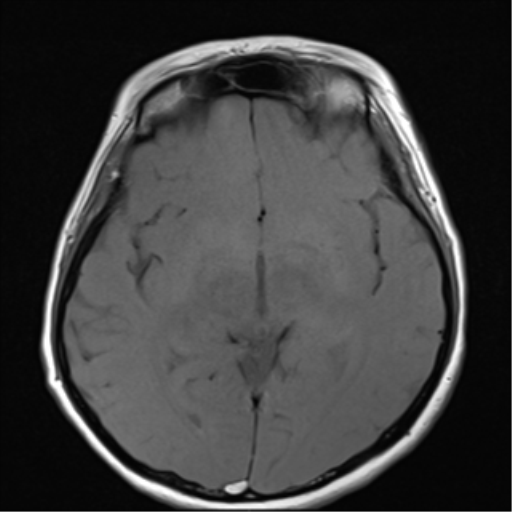File:Nasopharyngeal carcinoma with cerebral abscess (Radiopaedia 43018-46273 Axial T1 7).png