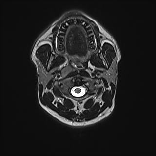 File:Nasopharyngeal carcinoma with perineural spread (Radiopaedia 55030-61380 Axial T2 35).jpg