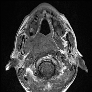 Nasopharyngeal carcinoma with skull base invasion (Radiopaedia 59258-66600 B 25).jpg