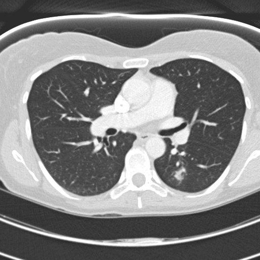 File:Necrobiotic pulmonary nodules - Crohn disease (Radiopaedia 20723-20631 Axial lung window 65).jpg