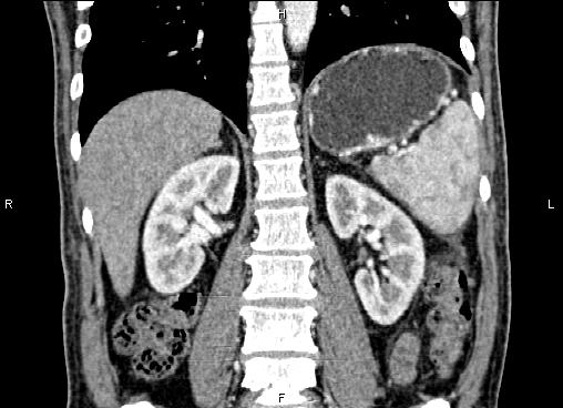 Necrotizing pancreatitis (Radiopaedia 87796-104248 F 46).jpg