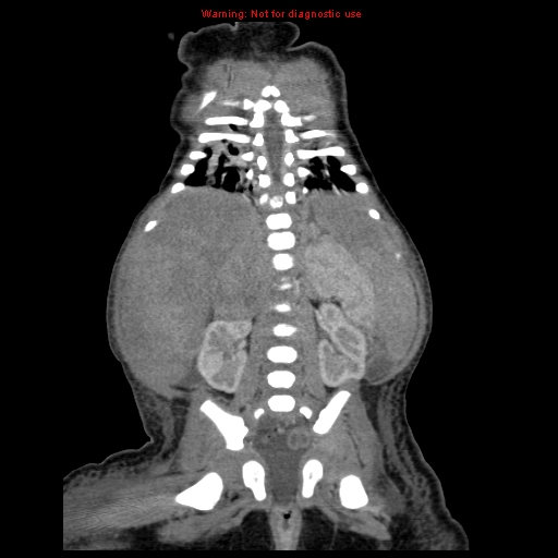 File:Neonatal neuroblastoma (Radiopaedia 9564-10223 B 90).jpg