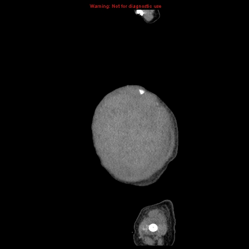 File:Neonatal neuroblastoma (Radiopaedia 9564-10223 C 10).jpg