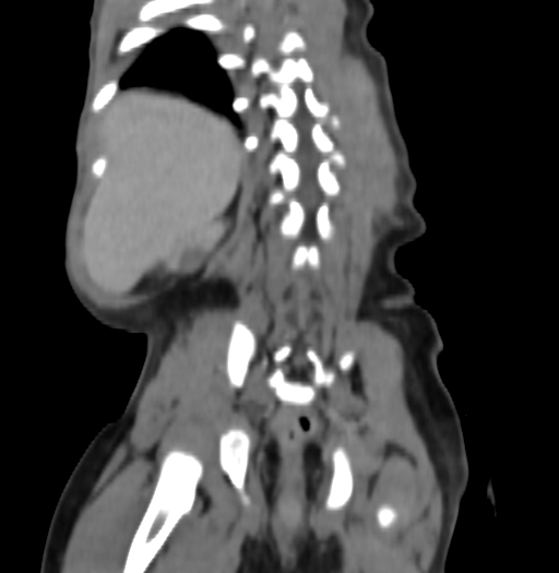 Nephroblastomatosis (Radiopaedia 71294-81607 B 279).jpg