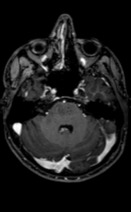 Neuro-Behçet disease (Radiopaedia 90112-107294 Axial T1 C+ 166).jpg