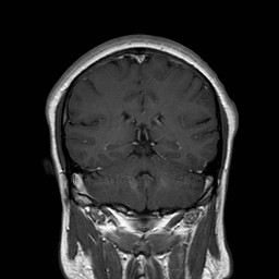 File:Neuro-Behcet's disease (Radiopaedia 21557-21505 Coronal T1 C+ 14).jpg