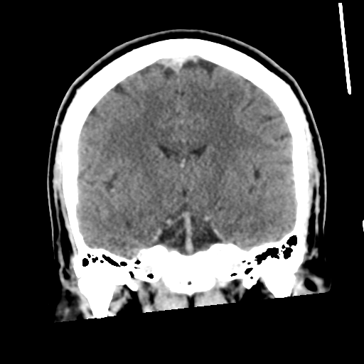 Neurocysticercosis - granular nodular (Radiopaedia 42786-45957 Coronal C+ 34).png