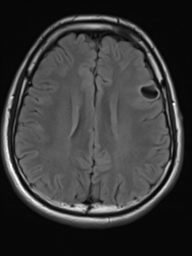 File:Neurofibromatosis type 2 (Radiopaedia 44936-48838 Axial FLAIR 16).png