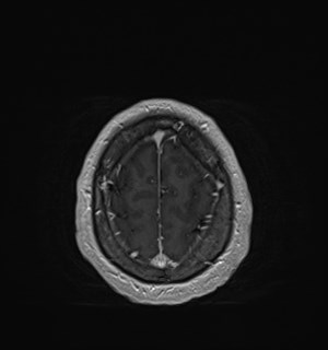 Neurofibromatosis type 2 (Radiopaedia 79097-92049 Axial T1 C+ 172).jpg