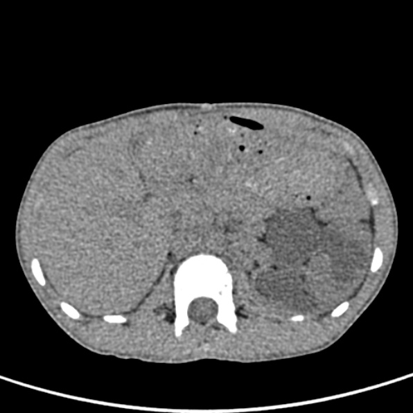 File:Neurogenic bladder (Radiopaedia 29058-29421 Axial non-contrast 9).jpg