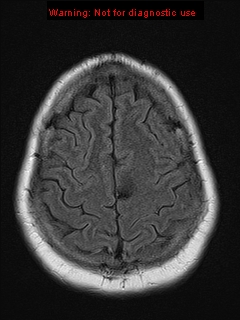 File:Neuroglial cyst (Radiopaedia 10713-11184 Axial FLAIR 4).jpg