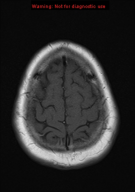 File:Neuroglial cyst (Radiopaedia 10713-11184 Axial T1 3).jpg