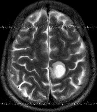 File:Neuroglial cyst (Radiopaedia 10780-11235 Axial T2 1).JPG