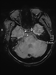 File:Neurotoxoplasmosis - concentric target sign (Radiopaedia 70644-80784 Axial SWI 13).jpg