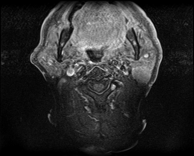 File:Non-Hodgkin lymphoma - parotid gland (Radiopaedia 71531-81890 Axial T1 C+ fat sat 11).jpg
