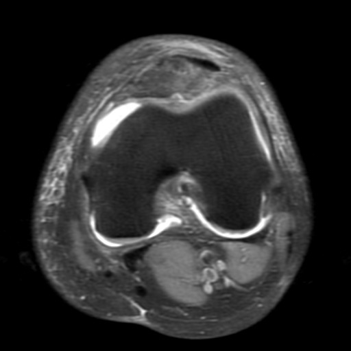 File:Non-displaced patella fracture (Radiopaedia 15932-15582 Axial PD fat sat 12).jpg