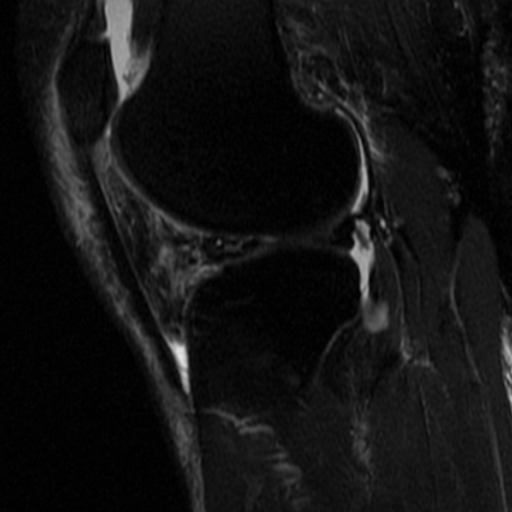File:Non-displaced patella fracture (Radiopaedia 15932-15582 Sagittal T2 fat sat 13).jpg