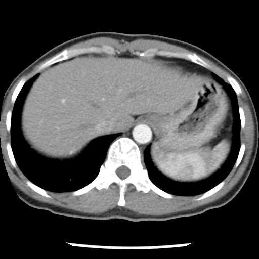 File:Non-small cell lung cancer with miliary metastases (Radiopaedia 23995-24193 A 35).jpg
