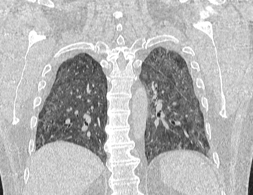 Non specific interstitial pneumonia (NSIP) (Radiopaedia 89725-106798 Coronal lung window 55).jpg