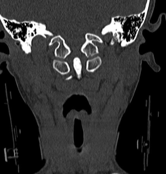 File:Normal CT cervical spine - 12-year-old (Radiopaedia 55352-61775 Coronal bone window 43).jpg
