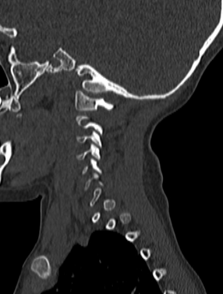 Normal CT cervical spine - pediatric (Radiopaedia 52549-58462 Sagittal bone window 182).jpg