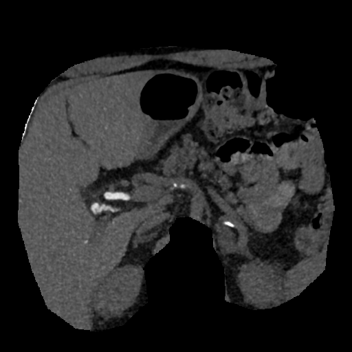 File:Normal CT intravenous cholangiogram (Radiopaedia 38199-40208 Axial IVC (MIP) 48).png