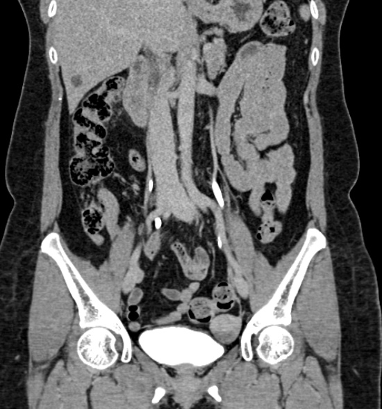 Normal CT intravenous urogram (Radiopaedia 39444-41759 A 259).jpg