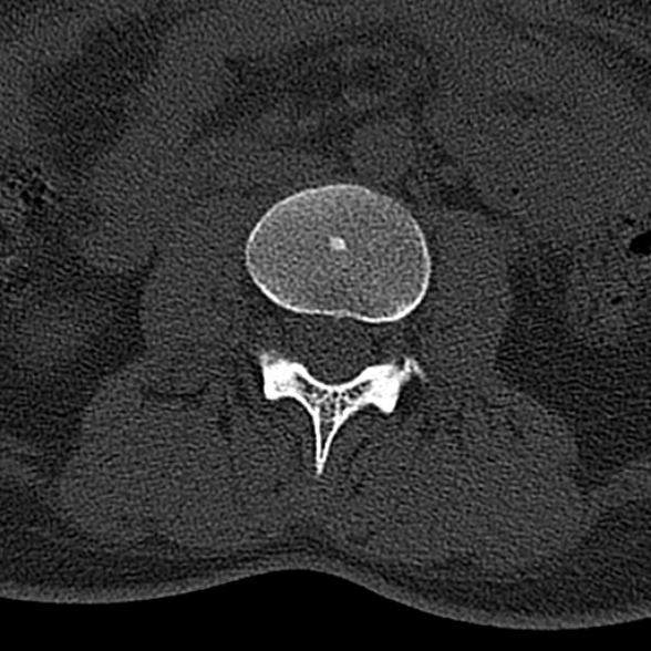 File:Normal CT lumbar spine (Radiopaedia 53981-60118 Axial bone window 37).jpg