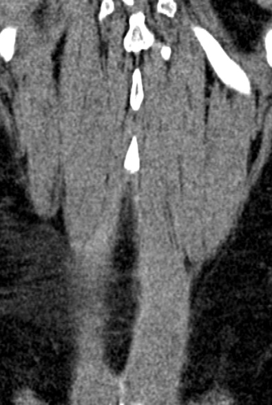 Normal CT lumbar spine (Radiopaedia 53981-60118 F 95).jpg