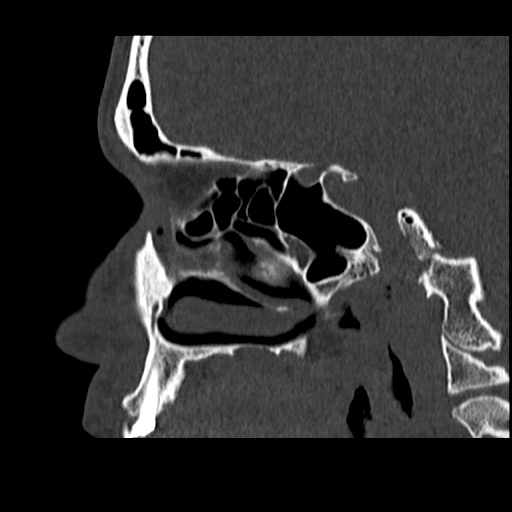 Normal CT paranasal sinuses (Radiopaedia 42286-45390 Sagittal bone window 38).jpg