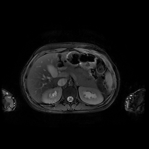 File:Normal MRI abdomen in pregnancy (Radiopaedia 88001-104541 D 15).jpg
