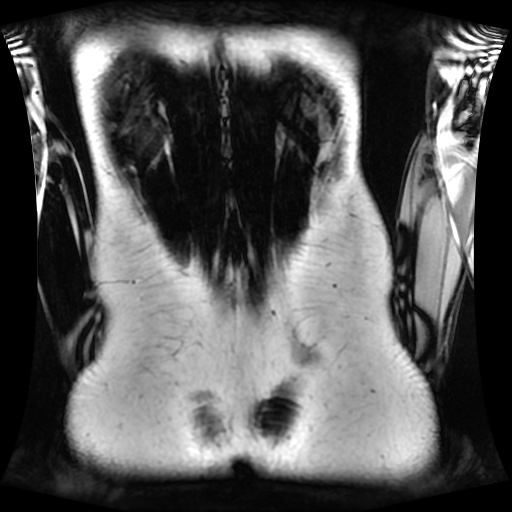 Normal MRI abdomen in pregnancy (Radiopaedia 88001-104541 N 123).jpg