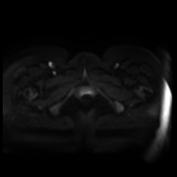Normal MRI abdomen in pregnancy (Radiopaedia 88005-104548 Axial DWI 77).jpg