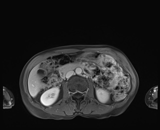 Normal adrenal glands MRI (Radiopaedia 82017-96004 M 46).jpg