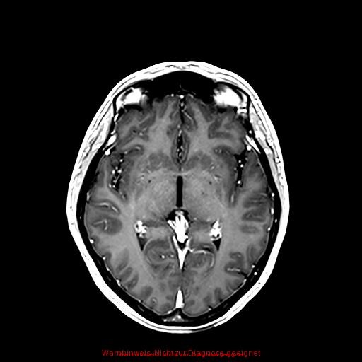 Normal adult brain MRI (non-enhanced and contrast-enhanced) (Radiopaedia 75262-86379 Axial T1 C+ 101).jpg