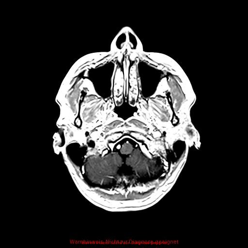 Normal adult brain MRI (non-enhanced and contrast-enhanced) (Radiopaedia 75262-86379 Axial T1 C+ 46).jpg
