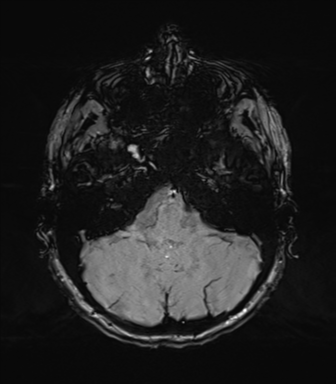 Normal brain MRI (TLE protocol) (Radiopaedia 40748-43405 Axial SWI 18).png