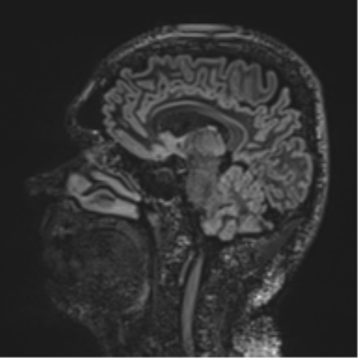 Normal brain MRI (non-focal epilepsy protocol) (Radiopaedia 53917-60040 Sagittal DIR 36).png